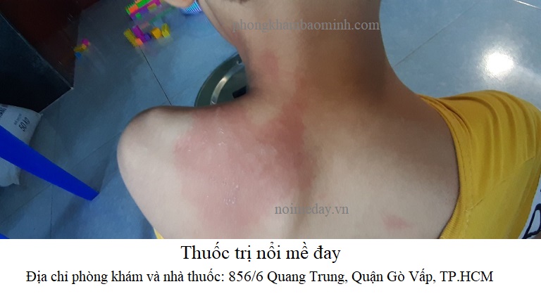 Thuốc trị mề đay